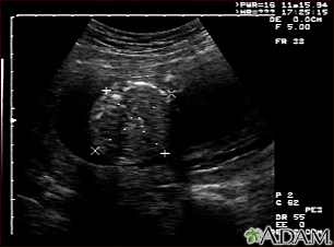 Ultrasound, normal fetus - abdomen measurements - Illustration Thumbnail                      