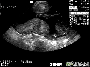 Ultrasound, normal placenta - Braxton Hicks - Illustration Thumbnail                      