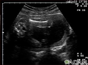 Ultrasound, normal fetus - femur measurement - Illustration Thumbnail                      