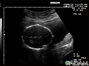 Ultrasound, normal fetus - head measurements - Illustration Thumbnail                      