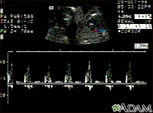 Ultrasound, ventricular septal defect - heartbeat - Illustration Thumbnail                      