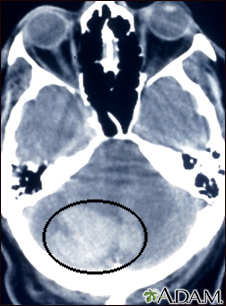 Intracerebellar hemorrhage - CT scan - Illustration Thumbnail                      