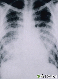 Chickenpox, acute pneumonia - chest X-ray - Illustration Thumbnail                      