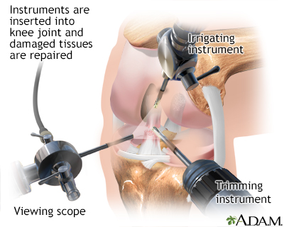 Knee arthroscopy - Illustration Thumbnail                      