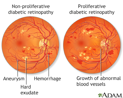 Diabetic retinopathy - Illustration Thumbnail                      