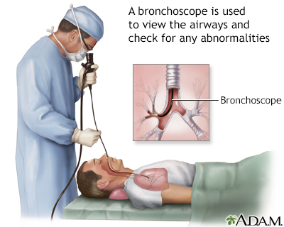 Bronchoscopy - Illustration Thumbnail                      