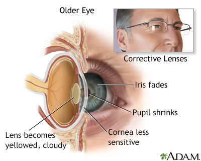 Aged eye anatomy - Illustration Thumbnail                      