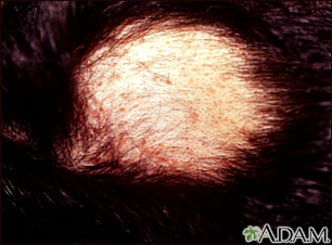 Alopecia areata with pustules - Illustration Thumbnail                      