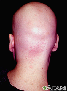 Alopecia totalis - back view of the head - Illustration Thumbnail                      