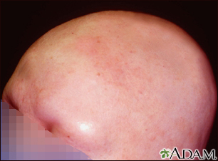 Alopecia totalis - front view of the head - Illustration Thumbnail                      