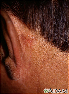 Skin cancer, basal cell carcinoma - behind ear - Illustration Thumbnail                      