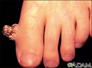 Wart (verruca) with a cutaneous horn on the toe - Illustration Thumbnail                      