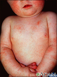 Dermatitis - atopic in an infant - Illustration Thumbnail                      