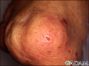 Dermatitis - herpetiformis on the knee - Illustration Thumbnail                      