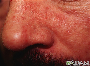 Dermatitis seborrheic - close-up - Illustration Thumbnail                      