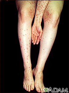 Dermatitis - herpetiformis on the arm and legs - Illustration Thumbnail                      