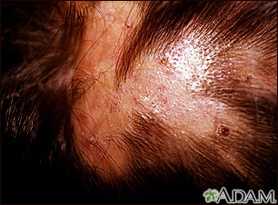 Folliculitis - decalvans on the scalp - Illustration Thumbnail                      