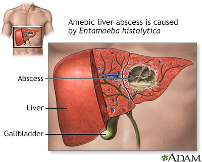 Amebic liver abscess - Illustration Thumbnail                      