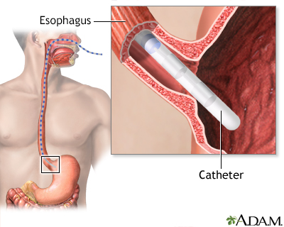 Esophageal manometry test - Illustration Thumbnail                      