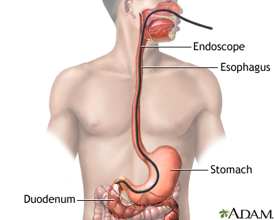 Esophagogastroduodenoscopy (EGD) - Illustration Thumbnail                      