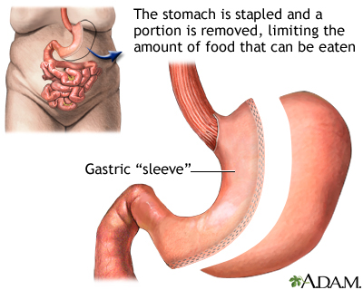 Gastric sleeve procedure - Illustration Thumbnail                      
