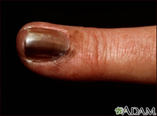 Skin cancer, melanoma on the fingernail - Illustration Thumbnail                      