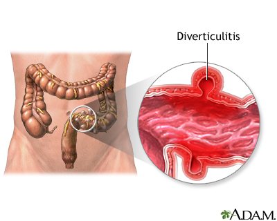 Diverticulitis - Illustration Thumbnail                      