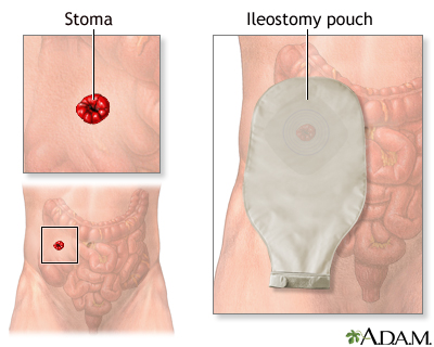 Ileostomy - stoma and pouch - Illustration Thumbnail                      