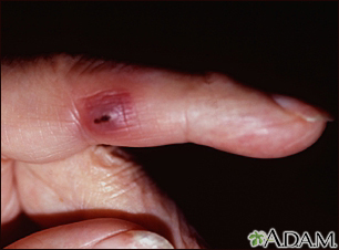 Janeway lesion on the finger - Illustration Thumbnail                      
