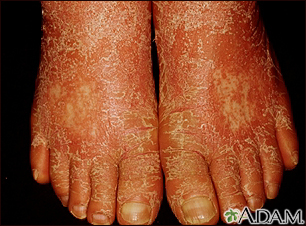 Pityriasis rubra pilaris on the feet - Illustration Thumbnail                      