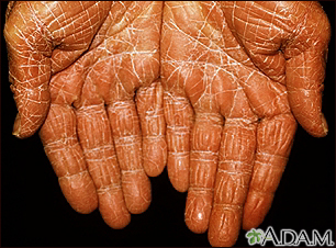 Pityriasis rubra pilaris on the palms - Illustration Thumbnail                      