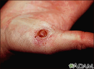 Pyogenic granuloma on the hand - Illustration Thumbnail                      