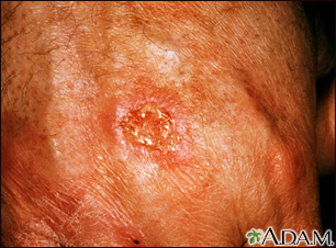 Skin cancer, squamous cell - close-up - Illustration Thumbnail                      