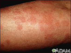 Hives (urticaria) on the arm - Illustration Thumbnail                      