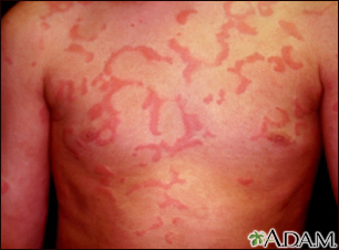 Hives (urticaria) on the chest - Illustration Thumbnail                      