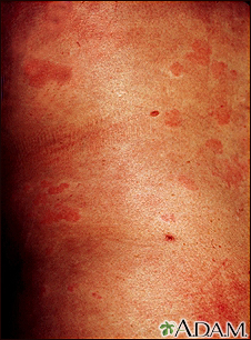 Hives (urticaria) on the trunk - Illustration Thumbnail                      