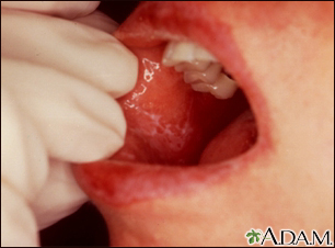 Lichen planus on the oral mucosa - Illustration Thumbnail                      