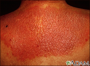 Lichen simplex chronicus on the back - Illustration Thumbnail                      