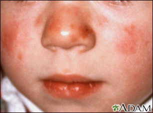 Lupus - discoid on a child's face - Illustration Thumbnail                      