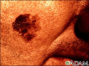 Skin cancer, close-up of lentigo maligna melanoma - Illustration Thumbnail                      