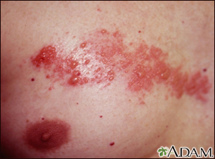 Herpes zoster (shingles) on the chest - Illustration Thumbnail                      