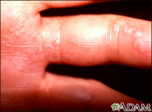 Herpes zoster (shingles) on the hand and fingers - Illustration Thumbnail                      
