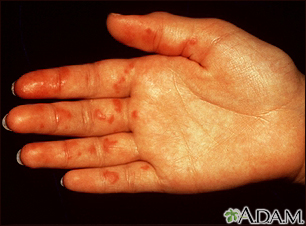 Vasculitis on the palm - Illustration Thumbnail                      