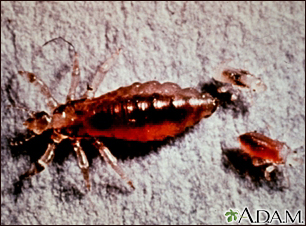 Body louse, female and larvae - Illustration Thumbnail                      