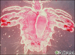 Crab louse, female - Illustration Thumbnail                      
