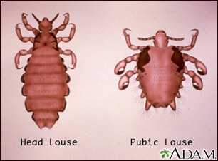 Head louse and pubic louse - Illustration Thumbnail                      