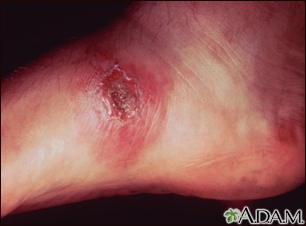 Leishmania panamensis on the foot - Illustration Thumbnail                      