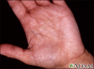 Hyperlinearity in atopic dermatitis - Illustration Thumbnail                      
