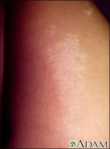 Lichen striatus - close-up - Illustration Thumbnail                      