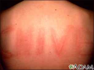 Dermatographism on the back - Illustration Thumbnail                      